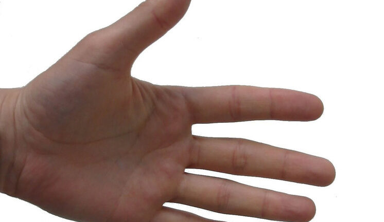 Школьницу избавили от потных ладошек